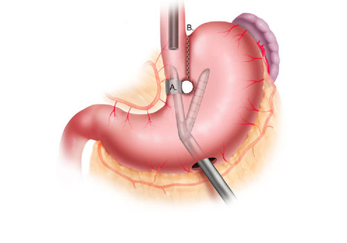 sleeve gastrectomy surgery in india