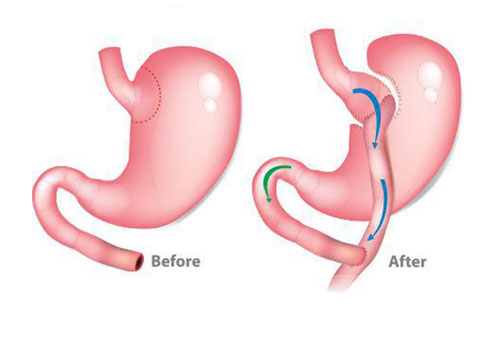 gastric bypass surgery in delhi