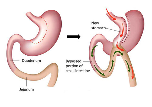 Gastric Mini Bypass Surgery in Delhi NCR