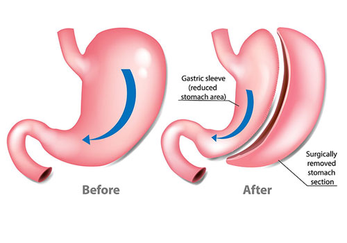 Sleeve Gastrectomy in Delhi NCR