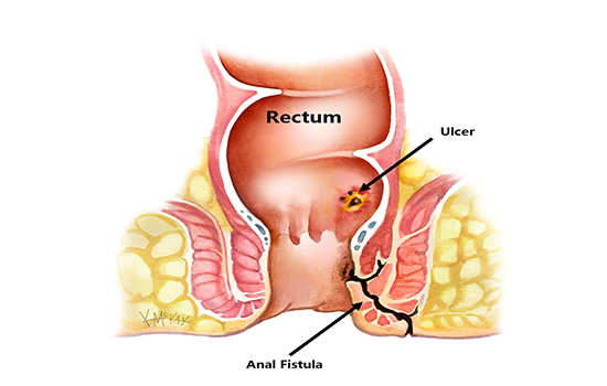 Best fistula surgery in delhi | Fistula treatment | Dr. Saggu