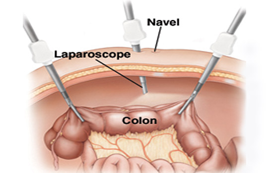 colon cancer treatment in delhi