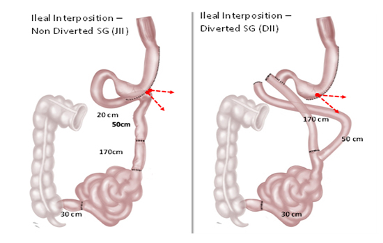 metabolic surgery for diabetes 