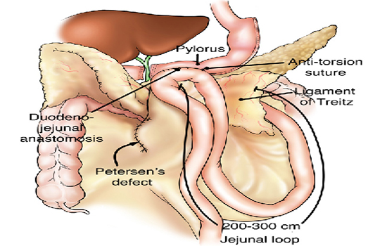 duodenojejunal bypass for diabetes