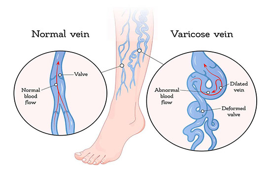 What are the Stages of Varicose Veins?