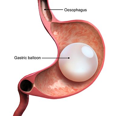 Intra Gastric Balloon