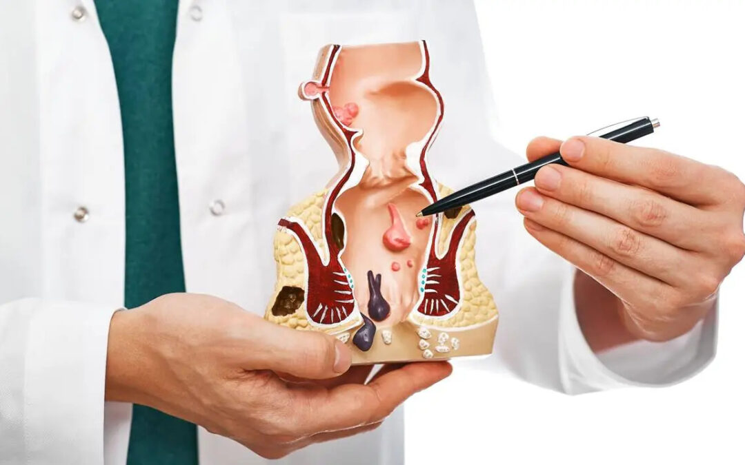 Difference Between Piles, Fissure and Fistula