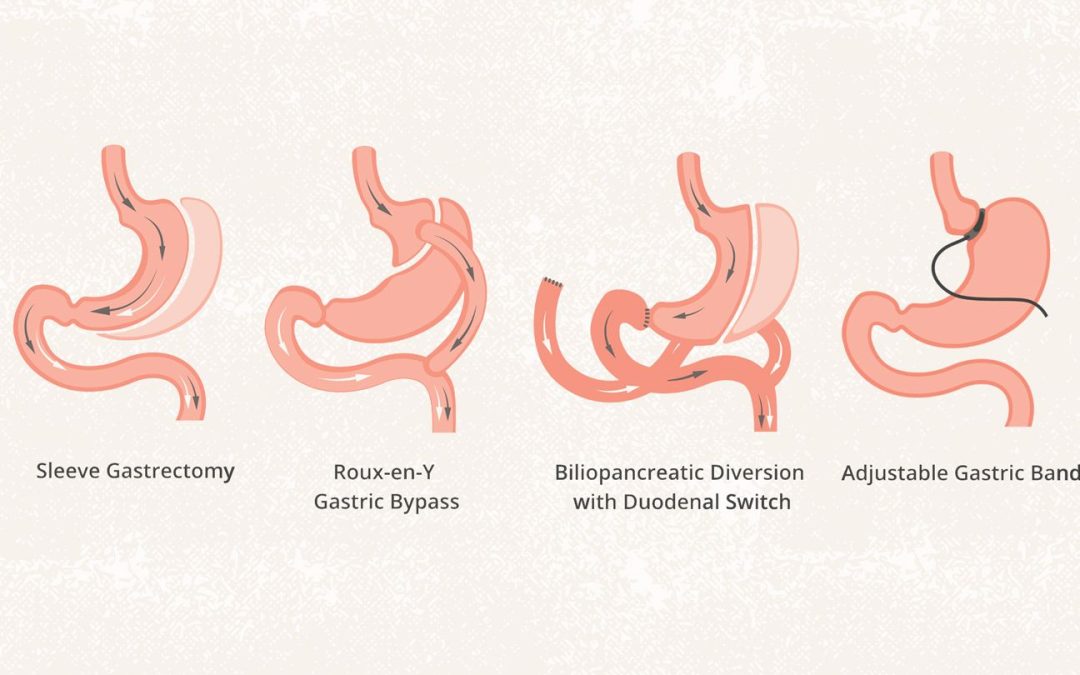 Types Of Bariatric Surgery