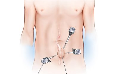 Is Hernia Surgery Necessary? When to consult a Doctor