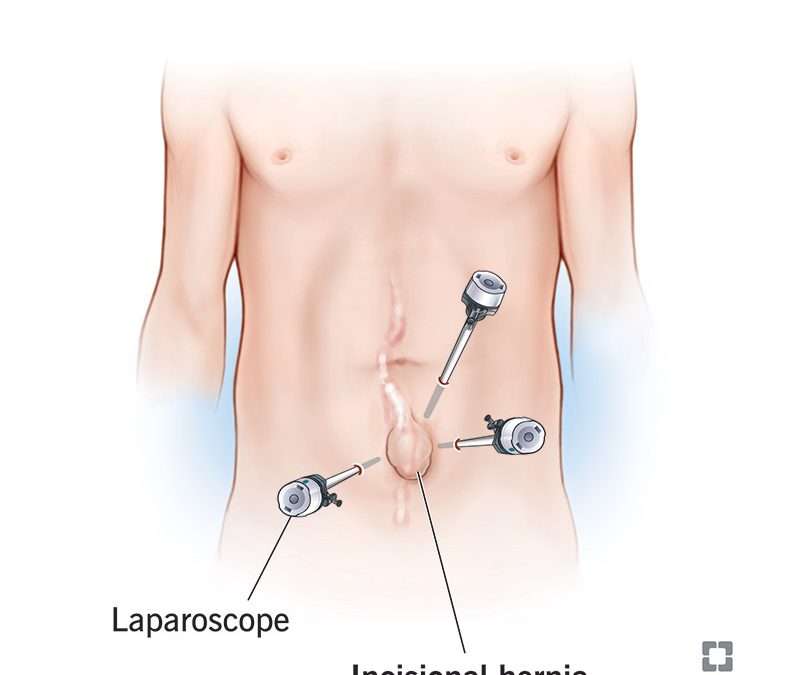 Is Hernia Surgery Necessary? When to consult a Doctor