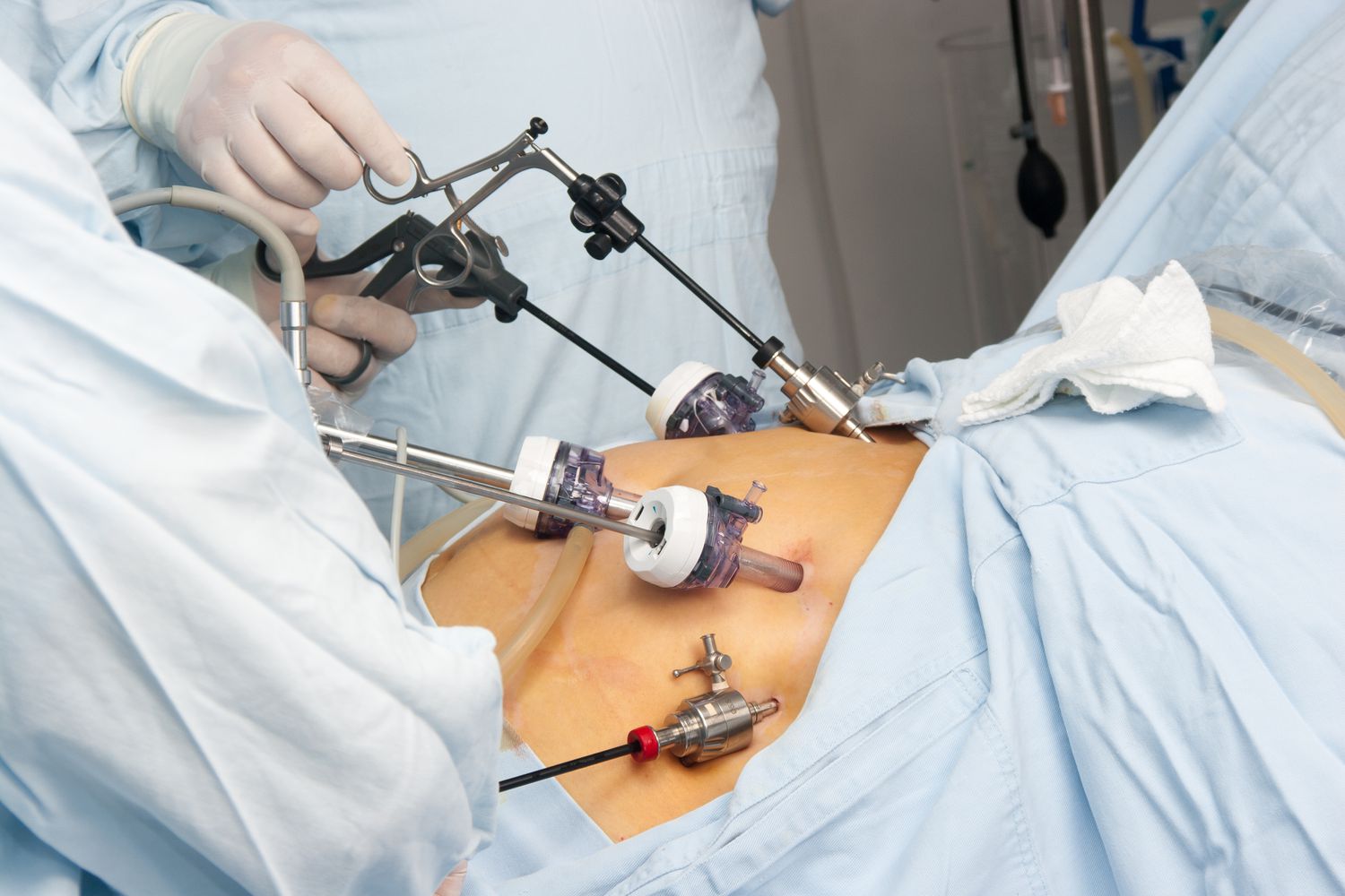 ROBOTIC bariatric surgery in delhi Best ROBOTIC bariatric surgery in delhi