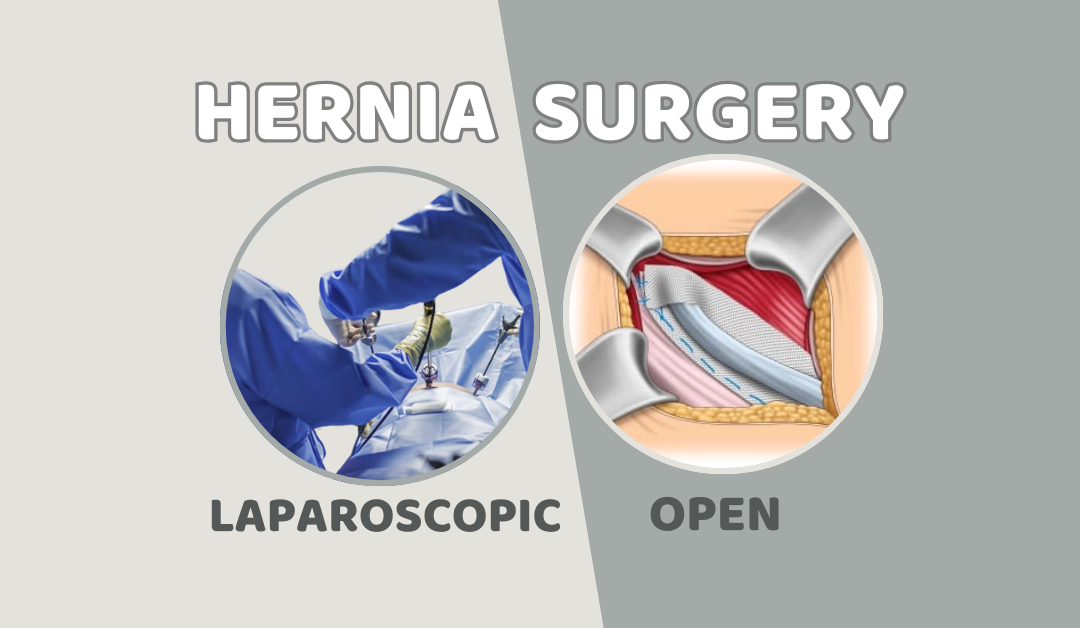 Open vs. Laparoscopic Hernia Surgery – Which One’s Better for You?
