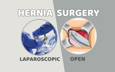 Open vs. Laparoscopic Hernia Surgery – Which One’s Better for You?