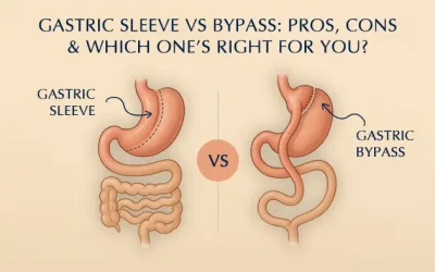 Gastric Bypass vs. Gastric Sleeve: Making the Best Choice for Your Health
